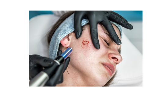 Microneedling: Collagen Induction or Collagen Destruction?