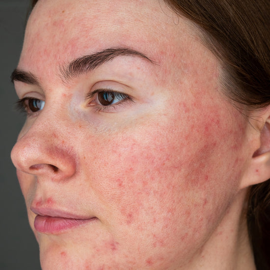 A woman's side profile showing her roasea before a skincare treatment by an esthetician.