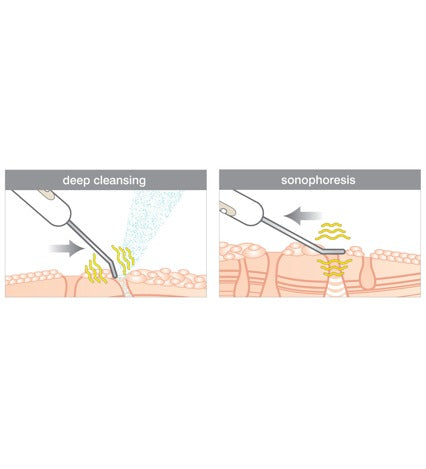 ULTRASONIC SKIN SCRUBBER (BT Micro)